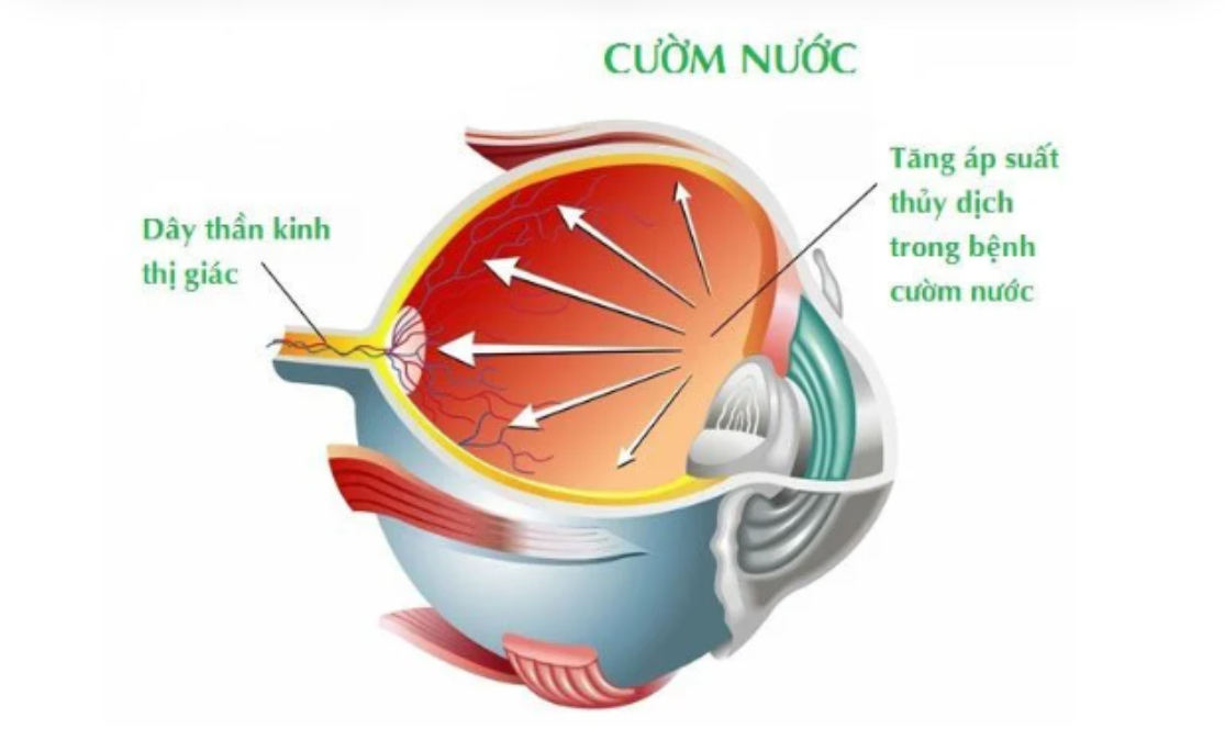 tang-ap-luc-noi-nhan-chen-ap-than-kinh-thi-giac