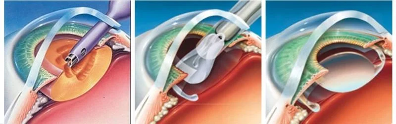 Phẫu thuật thay thủy tinh thể