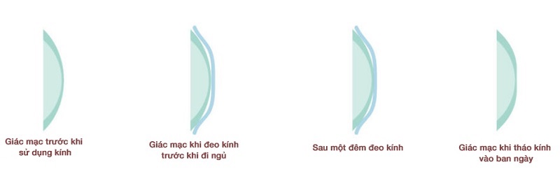 Cơ chế của kính Ortho-K