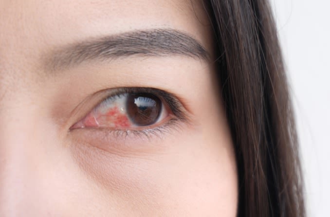 Nguyên nhân gây nên ngứa và sưng mi mắt