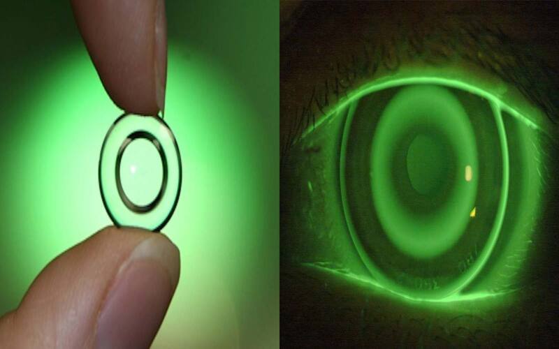 Kính áp tròng cận thị ortho-K là kính gì?
