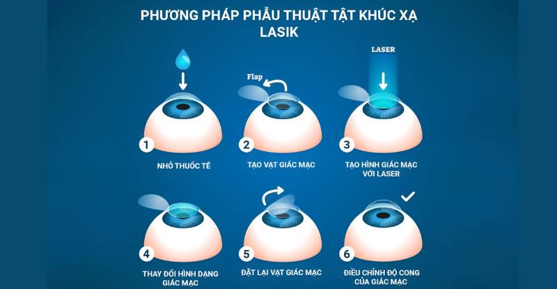 Phương pháp điều trị cận thị phẫu thuật tật khúc xạ Lasik