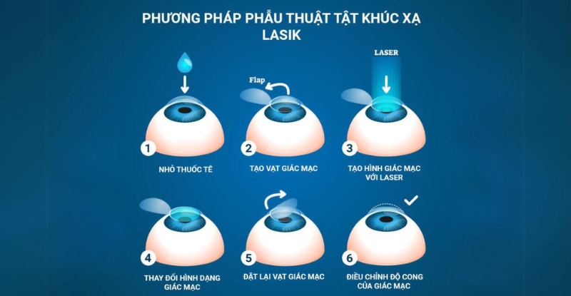 Các bước phẫu thuật Lasik