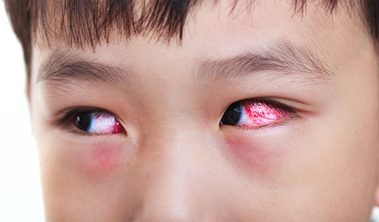 Mắt trẻ bị sưng do bị viêm giác mạc