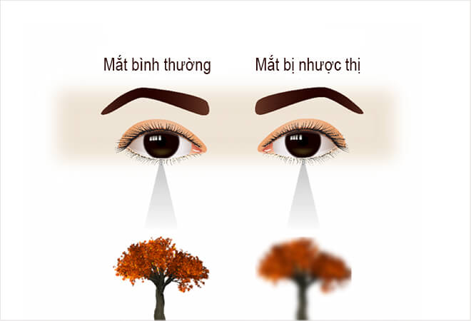 Khác biệt giữa mắt bình thường và mắt nhược thị