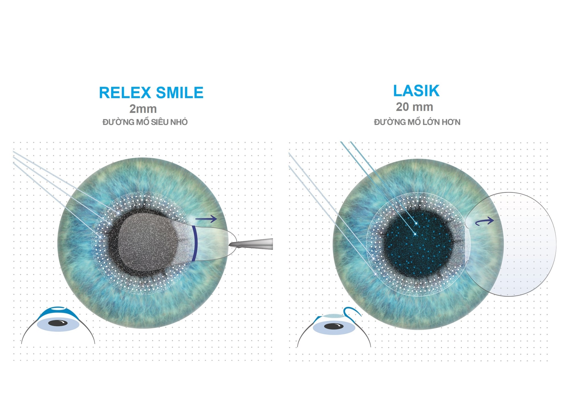 Phương pháp điều trị mắt cận bằng laser ReLEx Smile