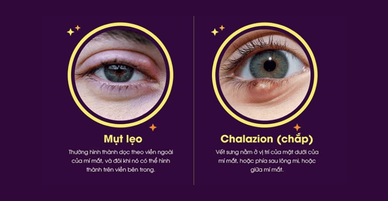 Triệu chứng chắp lẹo là gì? Viêm bờ mi có gây ra chắp lẹo không?