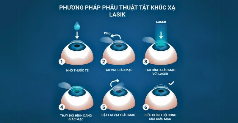 Các bước phẫu thuật tật khúc xạ bằng phương pháp LASIK