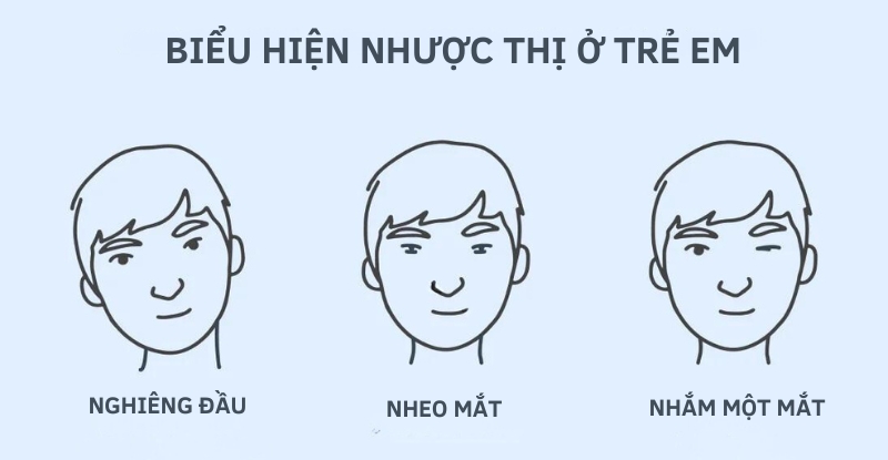 Biểu hiện nhược thị ở trẻ viễn thị