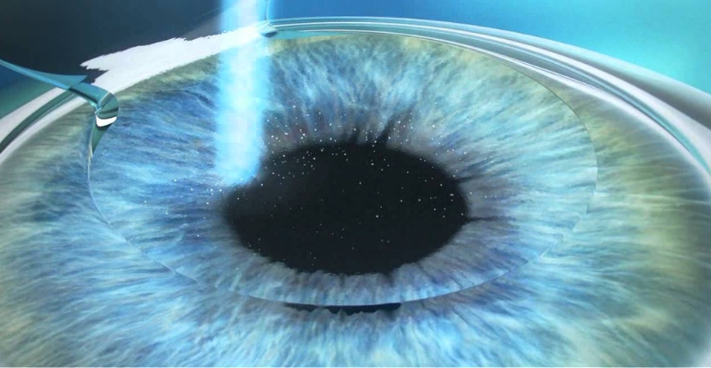 Mổ lasik có khả năng phục hồi nhanh