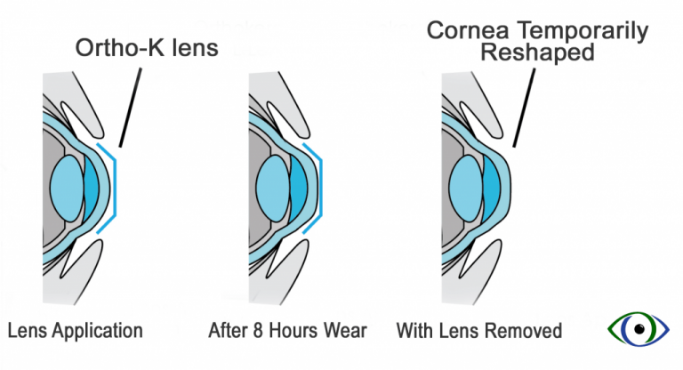 Thời gian làm quen với lens kính áp tròng Ortho-K