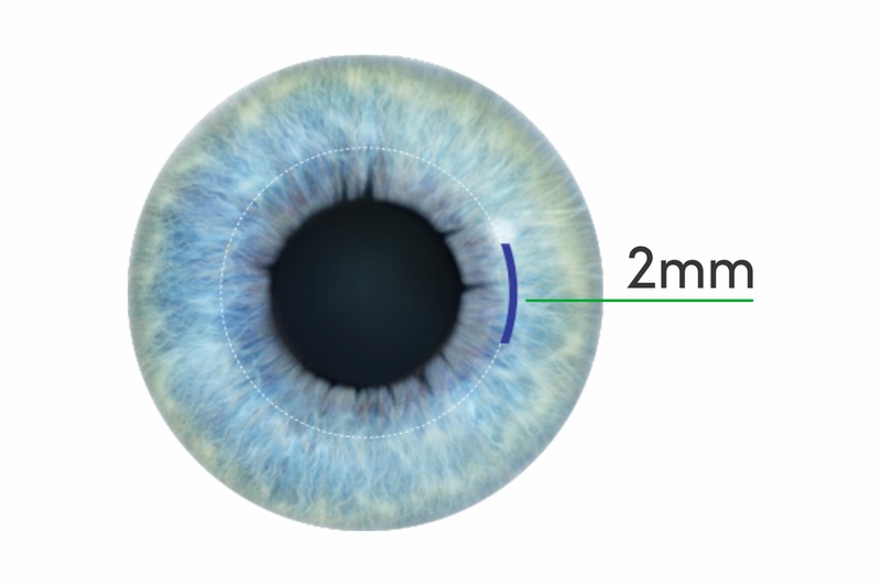 Phẫu thuật SMILE vạt 2mm