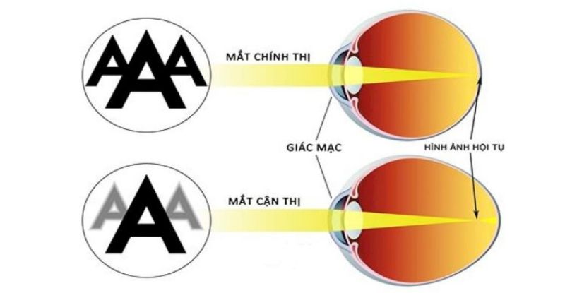 Mắt cận thị bị tăng độ nhanh là vấn đề mà nhiều người gặp phải