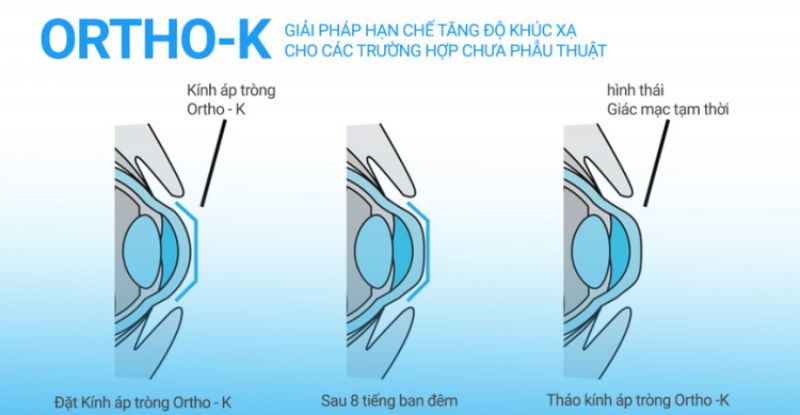 Dùng kính Ortho-K là cách để ngăn chặn tình trạng mắt cận thị bị tăng độ nhanh