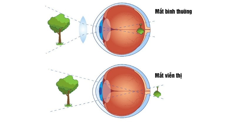 Mắt bình thường và mắt bị viễn thị