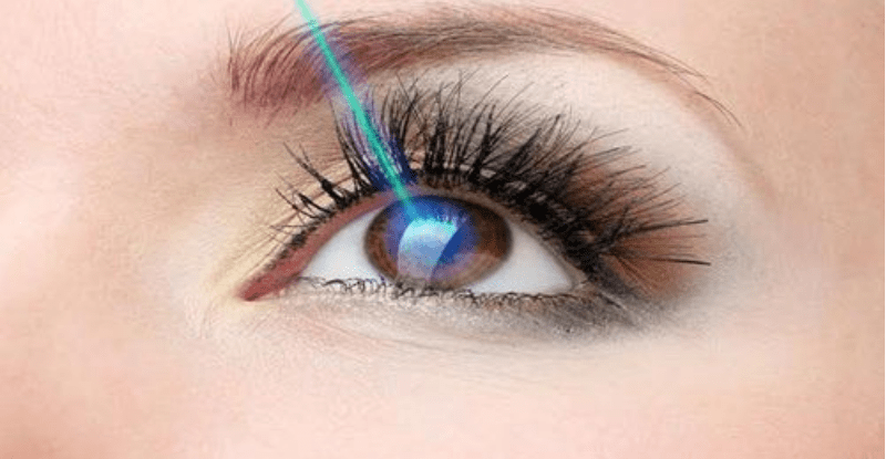 Phẫu thuật khúc xạ Lasik
