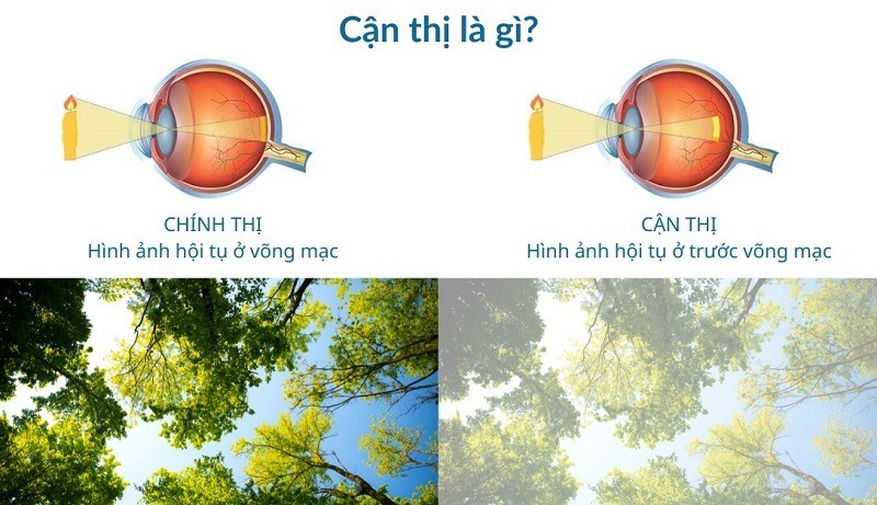 Độ cận thị ở trẻ em có thể tăng nhanh trong độ tuổi đi học, đặc biệt từ 8-15 tuổi
