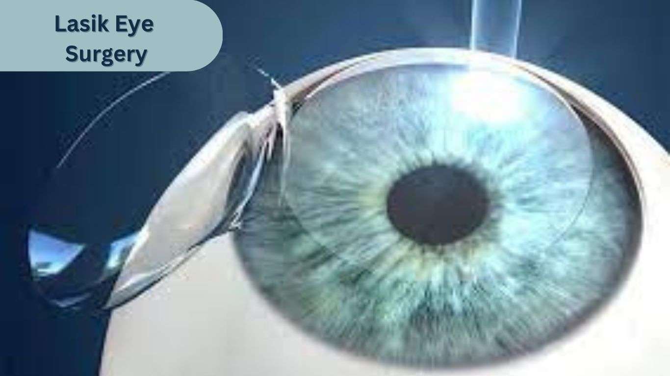 Phẫu thuật Lasik