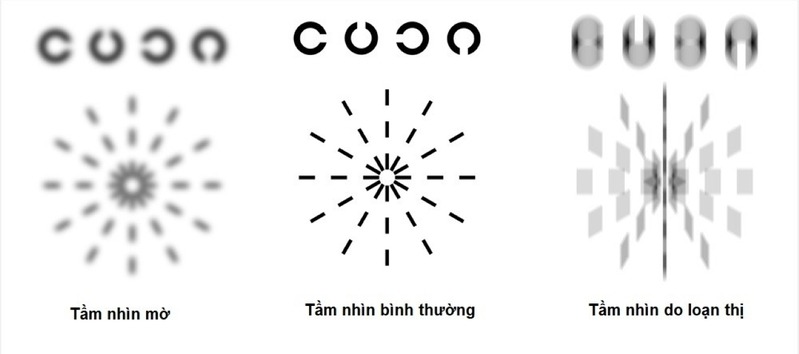Tầm nhìn của mắt bị loạn thị