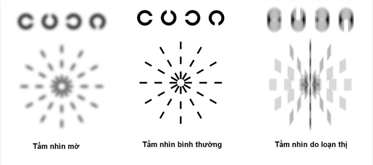 Tầm nhìn loạn thị gây méo hình