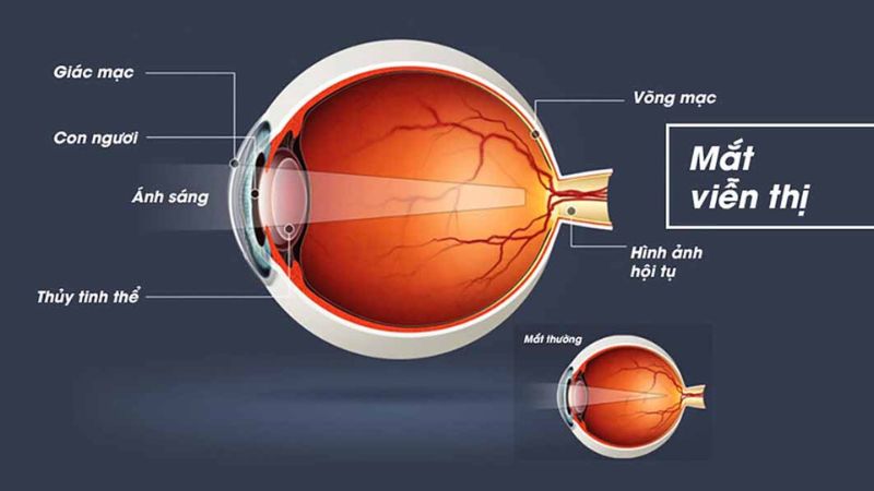 Cấu trúc mắt bị viễn thị