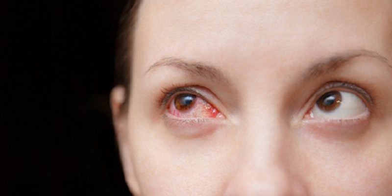 Yếu tố làm đau mắt đỏ tăng nguy cơ bị loạn thị