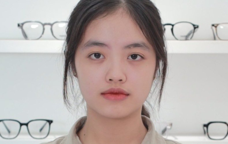 Bao lâu mổ cận thị mắt sẽ bớt dại?