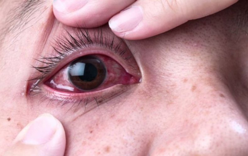 Nhiễm trùng hoặc viêm giác mạc sau mổ gây kéo dài tình trạng mắt dại