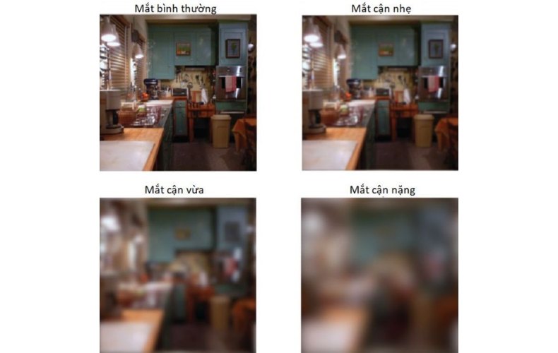 Giới thiệu về cận thị là gì?