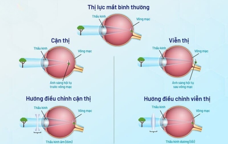 So sánh viễn thị và cận thị