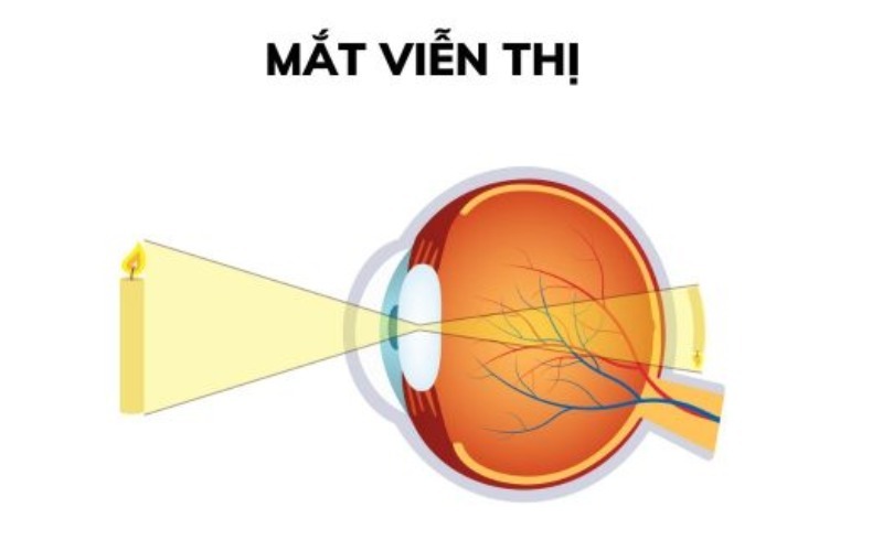 Viễn thị là gì?