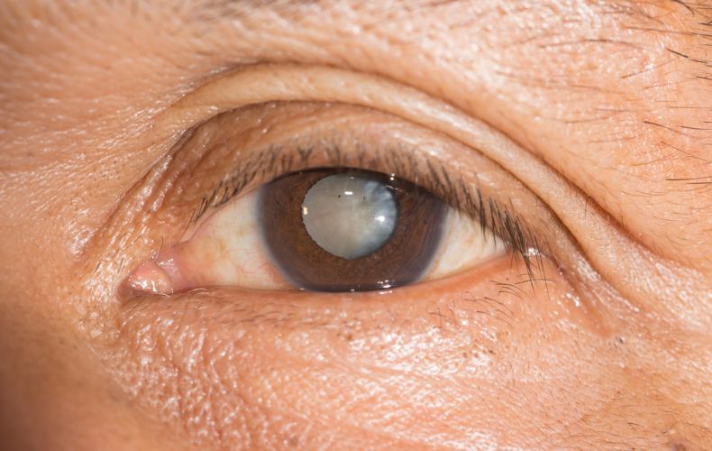 Đục thủy tinh thể (Cataract) là bệnh mắt thường gặp ở người già