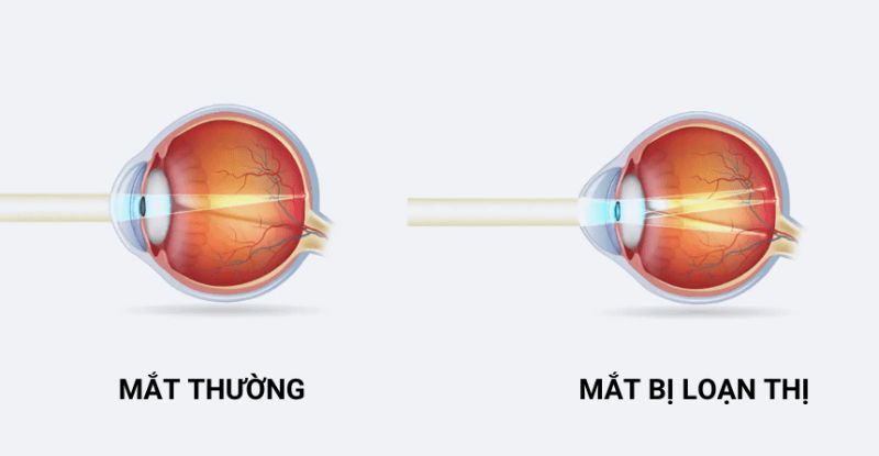 Loạn thị có hết được không? Dù loạn thị không tự khỏi, nhưng việc điều trị đúng cách có thể cải thiện tình trạng này và giúp thị lực rõ ràng hơn