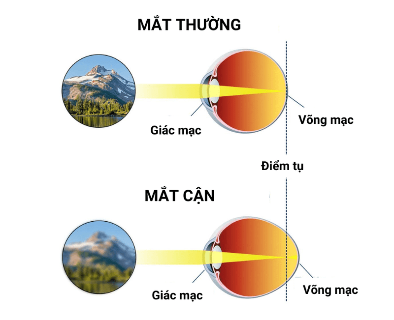 Cận thị 6 độ có thể kéo theo nhiều biến chứng nguy hiểm về mắt.