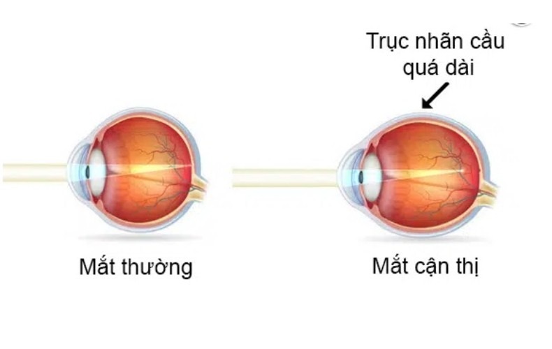 Phân loại cận thị theo cấu trúc mắt
