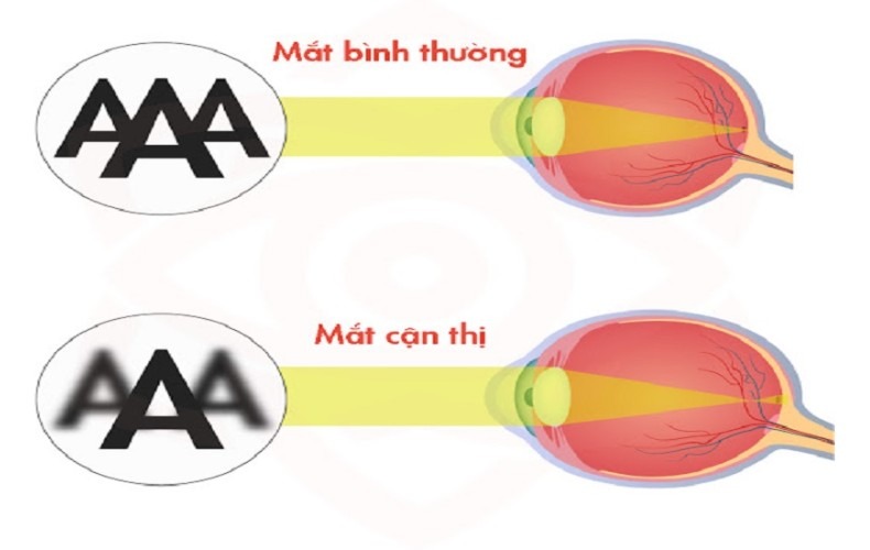 Cận thị là gì?