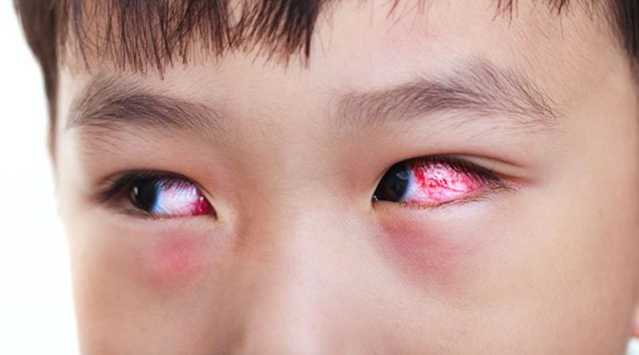 Khi nào đau mắt đỏ sau mổ loạn là dấu hiệu nguy hiểm?