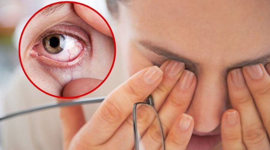 Cách chăm sóc mắt để giảm đau mắt đỏ sau mổ loạn