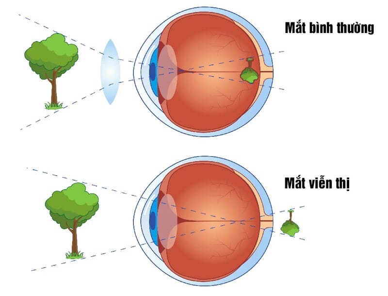 Hình ảnh minh họa mắt viễn thị