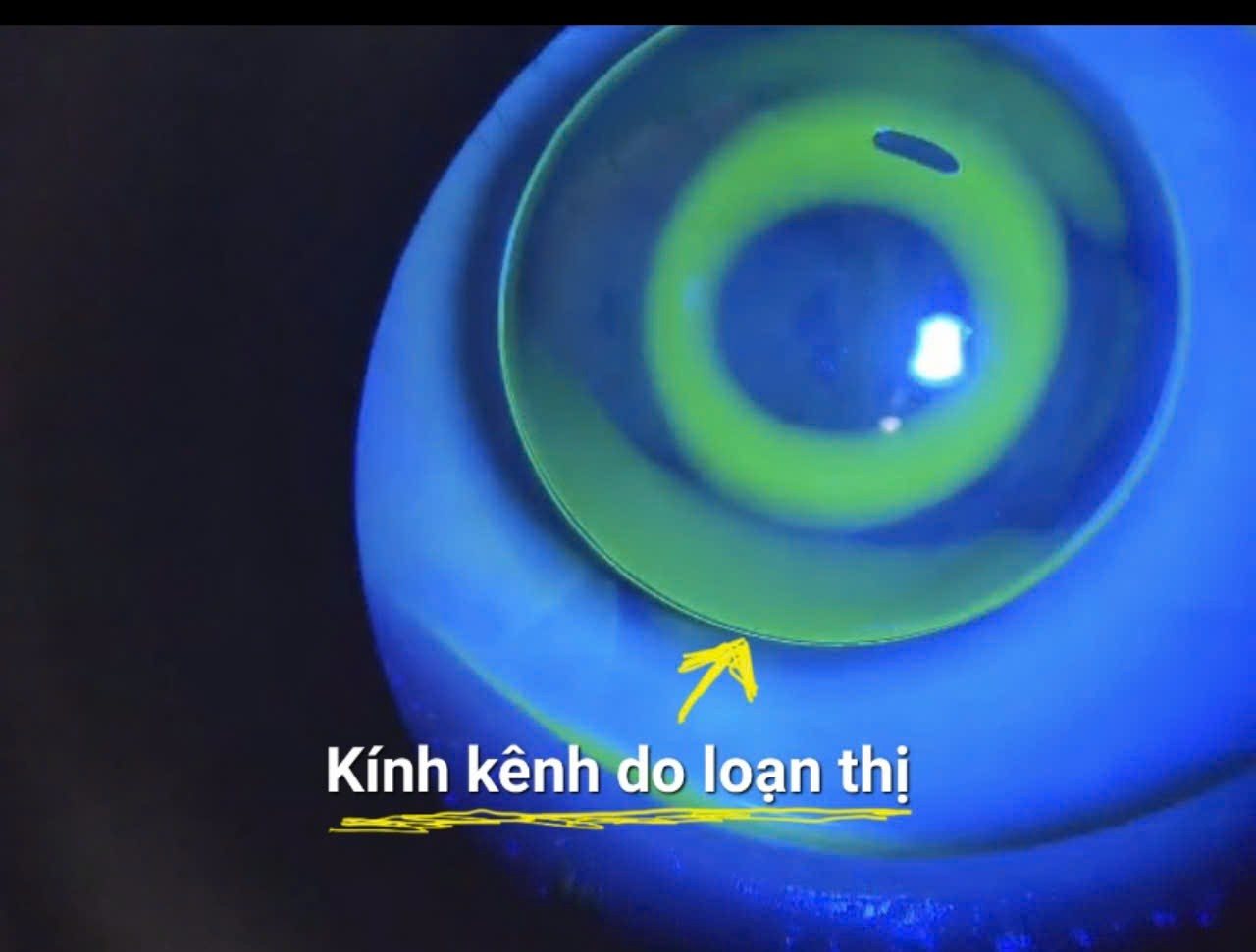 Kính kênh do loạn thị