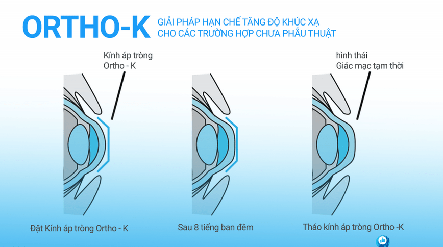 Đeo kính áp tròng