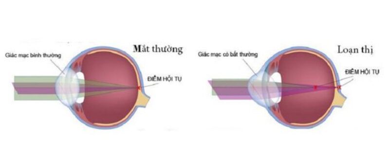 Loạn thị là tình trạng nhìn hình ảnh bị méo mó, không rõ nét ở mọi khoảng cách.