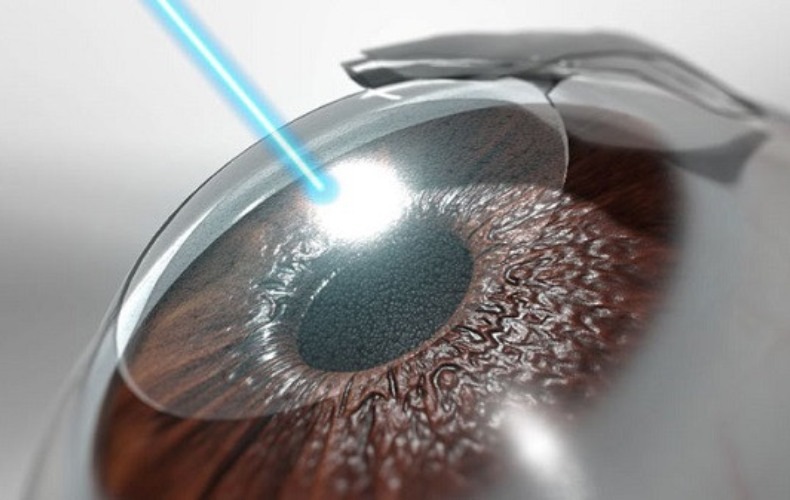 Phương pháp mổ cận Femto LASIK phù hợp với bệnh nhân cận thị cao