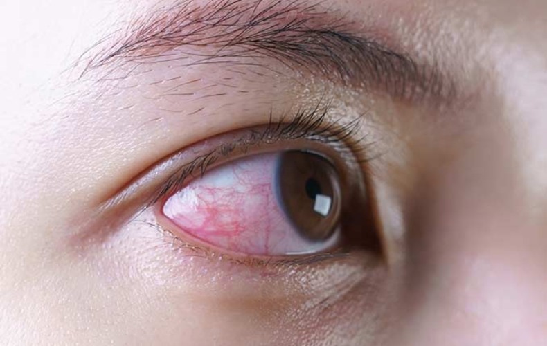 Mổ mắt cận bị dính nước sớm có thể nguy cơ nhiễm trùng