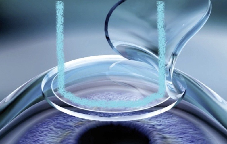 Phẫu thuật mổ cận LASIK/Femto LASIK