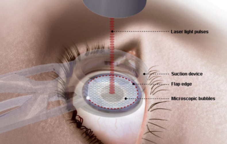 Phương pháp mổ Lasik là gì?
