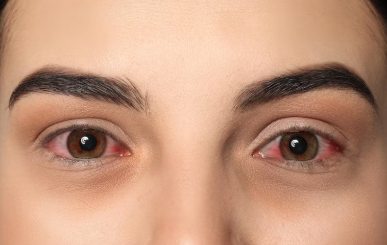 Bệnh đau mắt đỏ là gì?