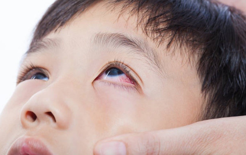 Mắt đỏ một bên có khả năng lan sang bên kia không?