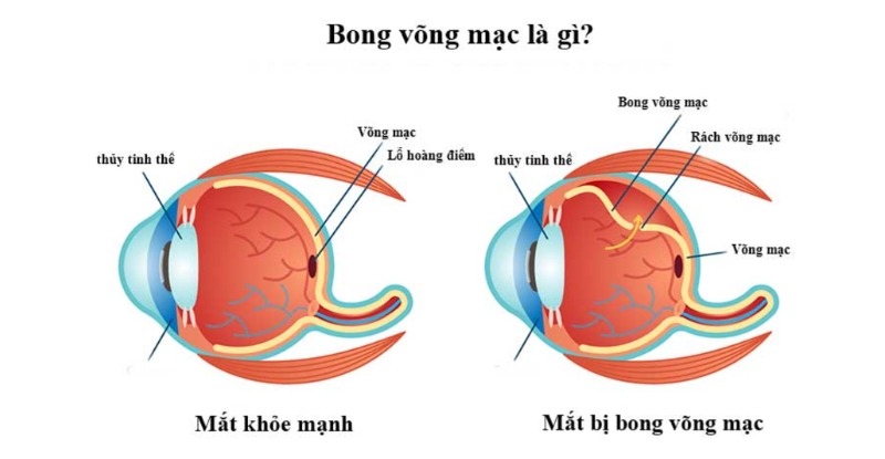 Bong võng mạc