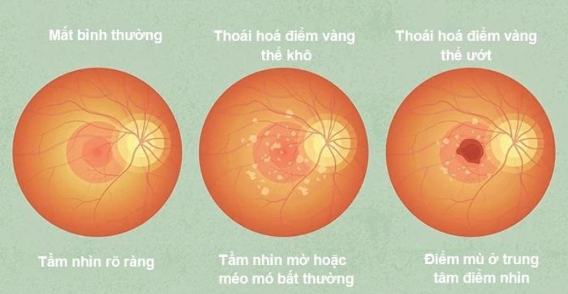 Thoái hóa hoàng điểm